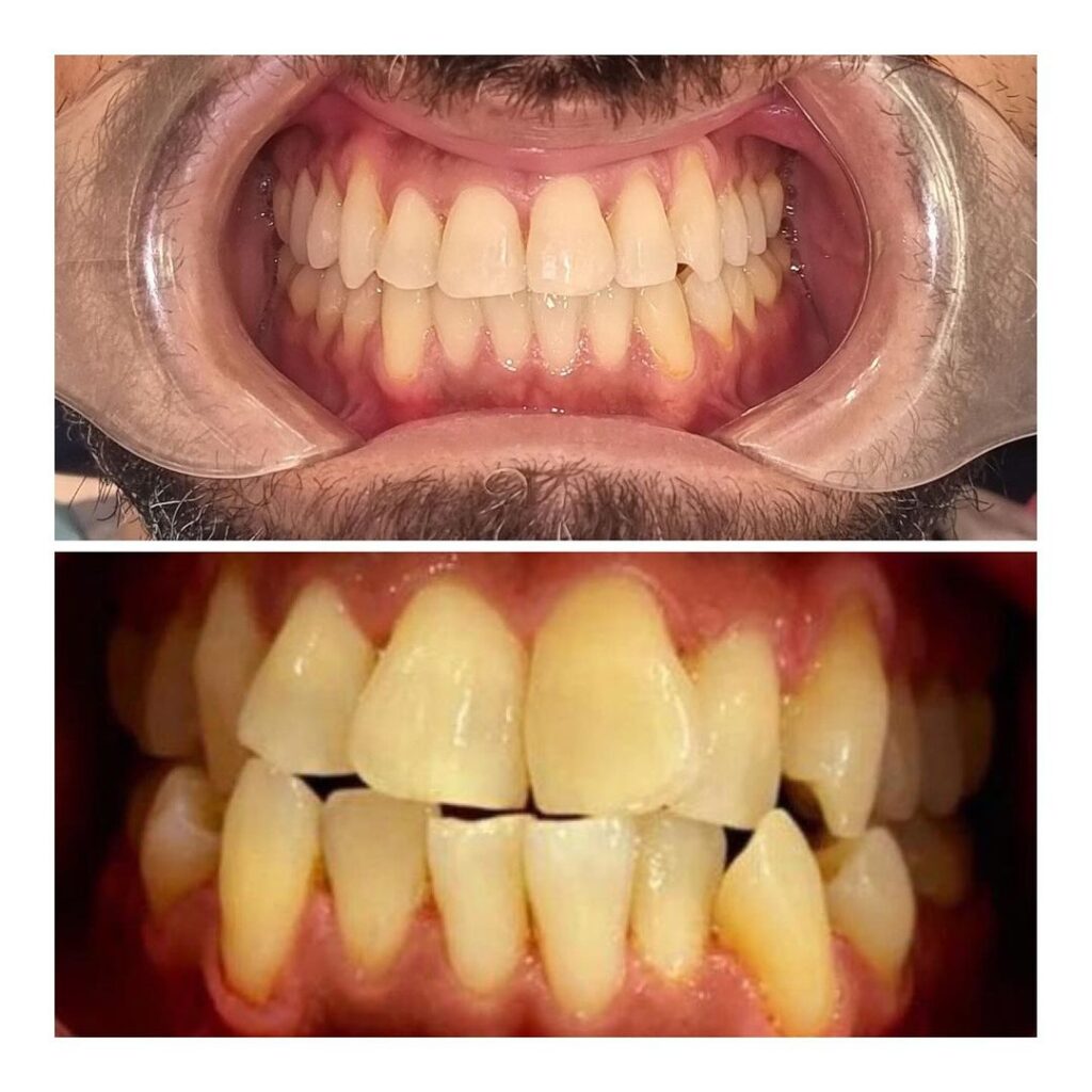 Invisalign