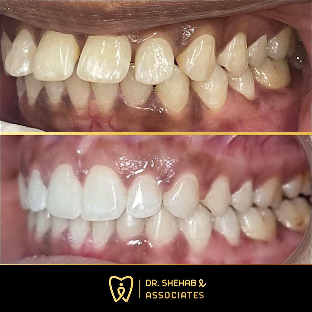 Invisalign – Align Polyclinic